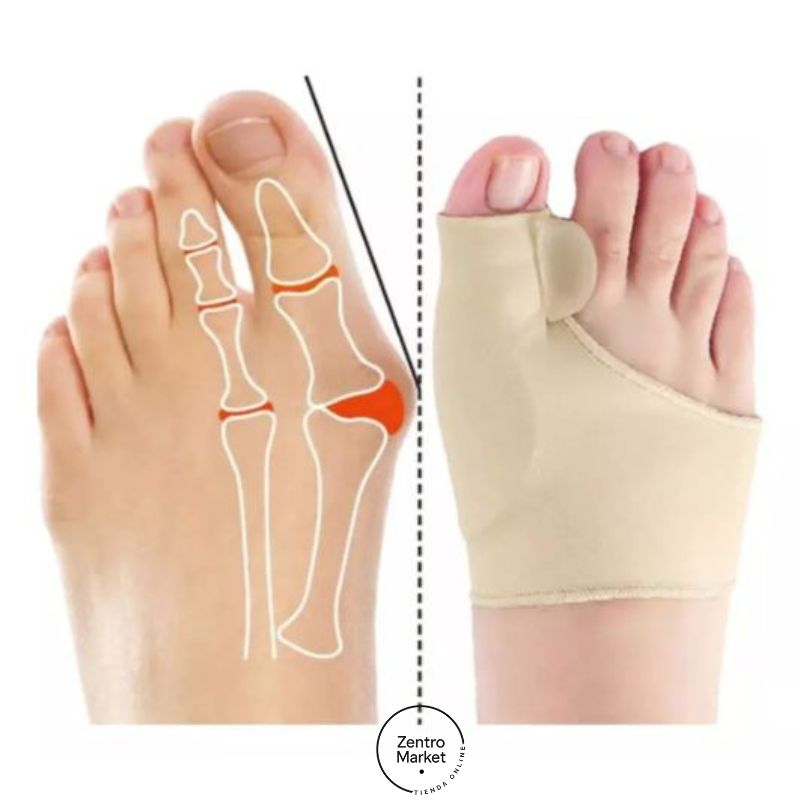 3x1 Corrector de Juanetes Ultrafino® - Comodidad al caminar