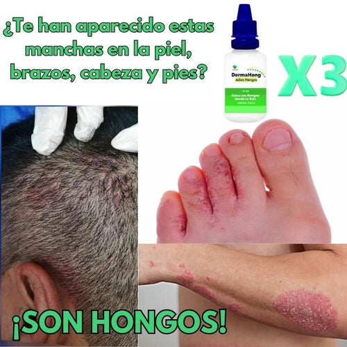 Dermahong® 3X1 – ¡Despídete de los Hongos! - 3 meses de tratamiento