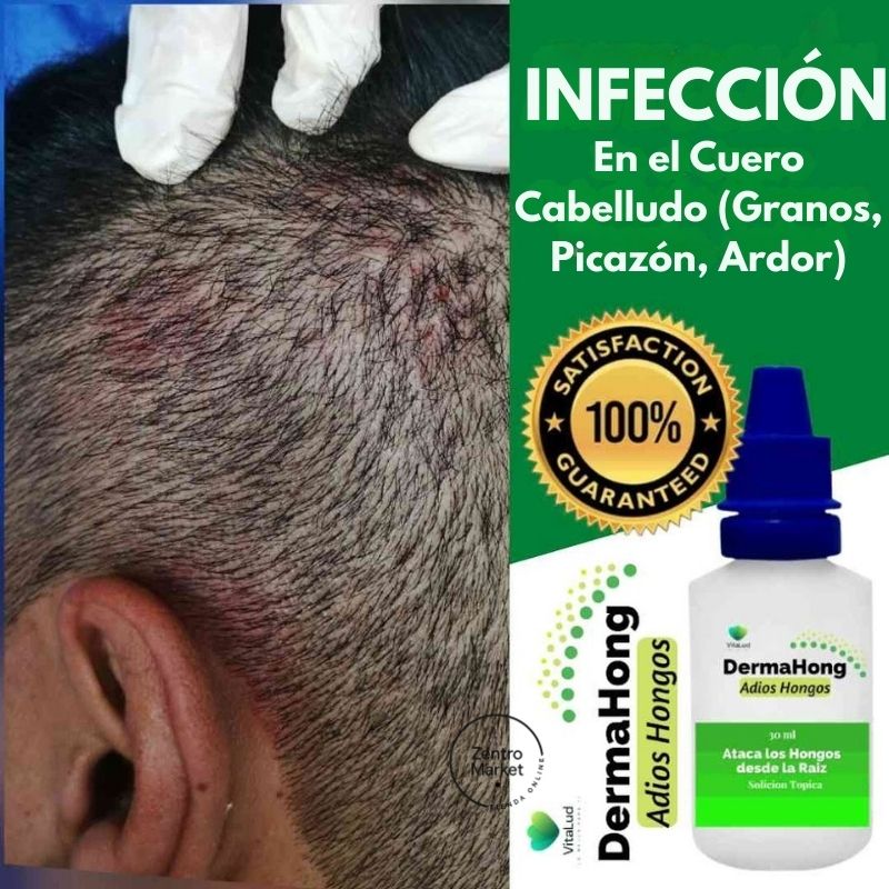 Dermahong® 3X1 – ¡Despídete de los Hongos! - 3 meses de tratamiento