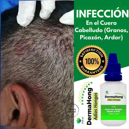 Dermahong® 3X1 – ¡Despídete de los Hongos! - 3 meses de tratamiento