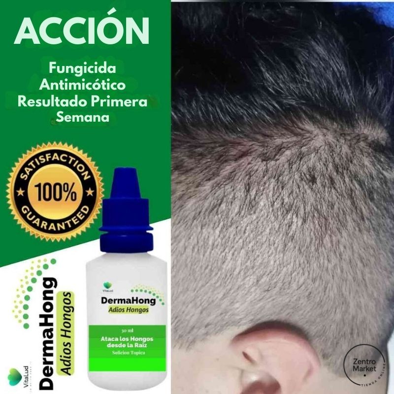 Dermahong® 3X1 – ¡Despídete de los Hongos! - 3 meses de tratamiento