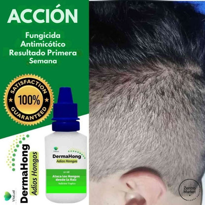 Dermahong® 3X1 – ¡Despídete de los Hongos! - 3 meses de tratamiento